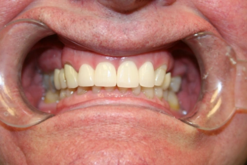 Brian after cosmetic smile makeover