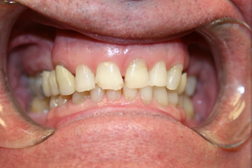 Brian before cosmetic smile makeover