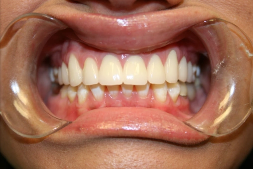 Claudia after cosmetic dental treatment