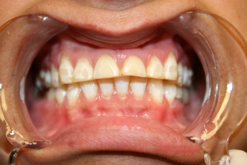 Claudia before cosmetic dental treatment