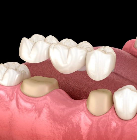 Illustration of a dental bridge replacing missing teeth