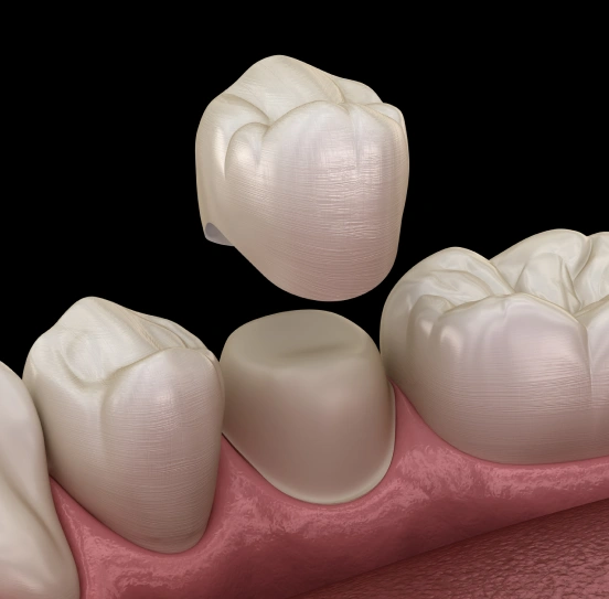 Illustration of a custom dental crown
