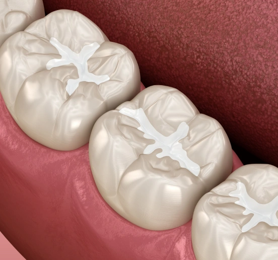 Illustration of protective dental sealants
