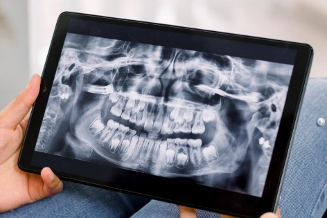 Digital dental X-ray displayed on a tablet for diagnosis