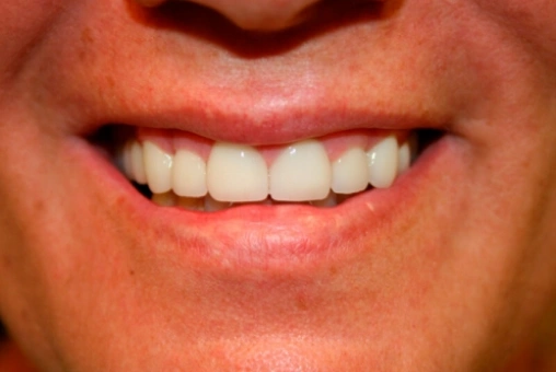 Holly after smile makeover