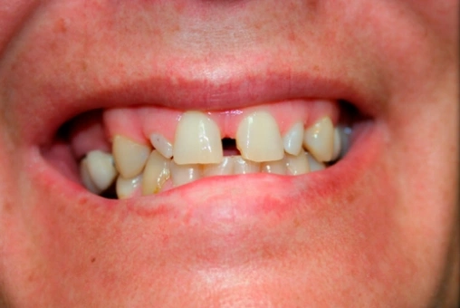 Holly before smile makeover