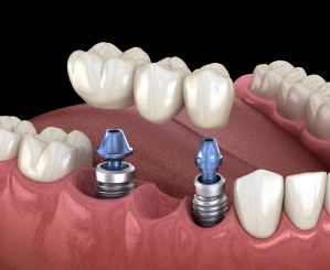 Illustration of an implant-supported dental bridge replacing multiple missing teeth