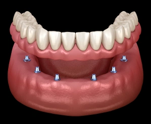 Illustration of implant-supported dentures secured with multiple dental implants