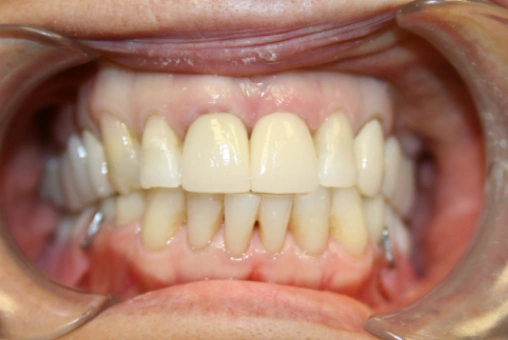 Smile after Lava crown treatment