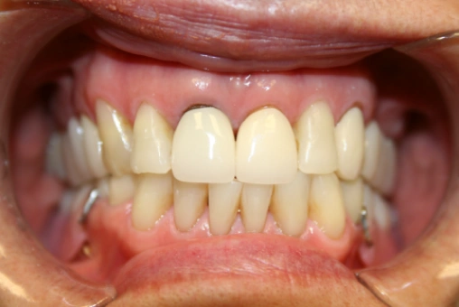Smile before Lava crown treatment