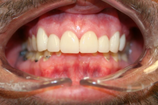 Ryan's smile after treatment with Lava dental crowns