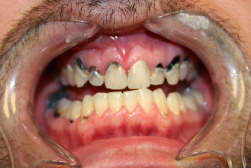 Ryan's smile before treatment with Lava dental crowns