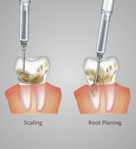 Illustration showing the scaling and root planing procedure for gum disease