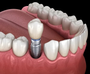 Illustration of a single dental implant replacing a missing tooth