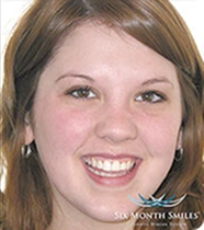 Patient smile after Invisalign treatment