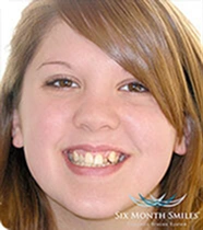 Patient smile before Invisalign treatment