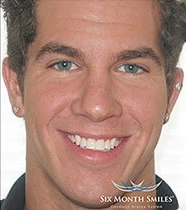 Smile after Invisalign teeth straightening treatment