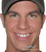 Smile before Invisalign teeth straightening treatment
