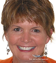 Teeth after clear aligner orthodontic treatment
