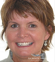 Teeth before clear aligner orthodontic treatment