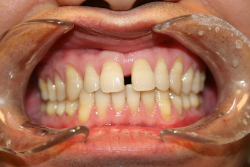 Smile before receiving Lava dental crowns