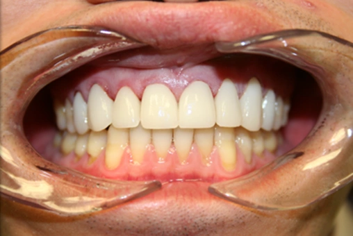 Smile after receiving Lava dental crowns